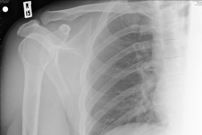 X-Ray of a right shoulder.