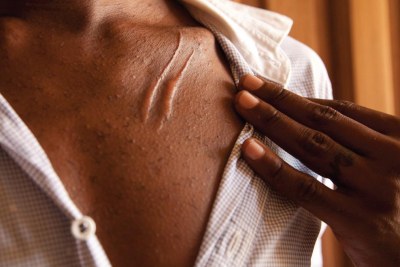 Un habitant de la région côtière du Kenya exhibe une cicatrice issue d’une attaque  par un groupe de jeunes hommes l’ayant accusé d'être gay. © 2015 Zoe Flood