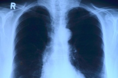 Lung x-ray.