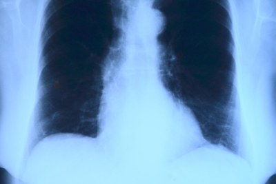 Lung x-ray (file photo).